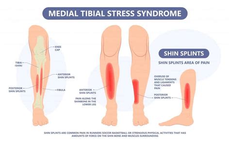 Shin Splints Treatment | Learn How To Treat Shin Splints