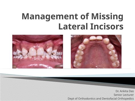 management  missing lateral incisorspptx