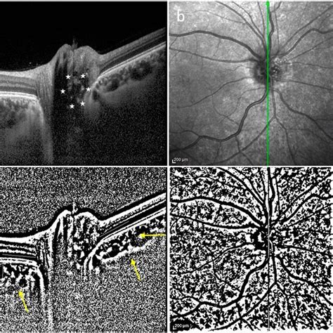 Illustration Of Peripapillary Choroidal Vascularity Index Measurement Download Scientific