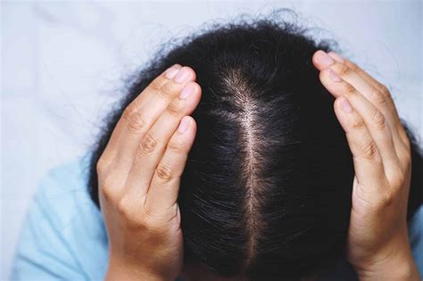 L Impact Psychologique De La Perte De Cheveux Chez Les Femmes Uplike