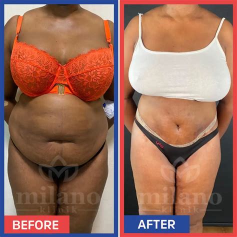 360 Degree Tummy Tuck Abdominoplasty Cost In Turkey