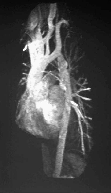 Figure 1 From Serial Pressure Gradients Across A Thoracic Coarctation Of The Aorta During