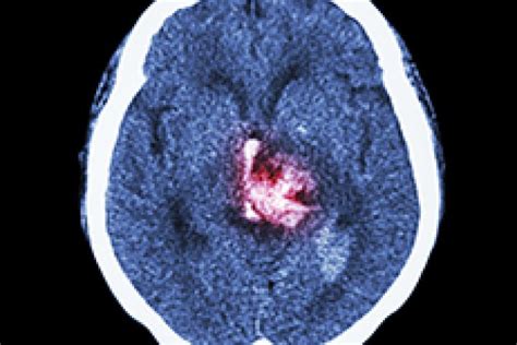 Cerebral Palsy Facts | Cerebral Palsy Foundation