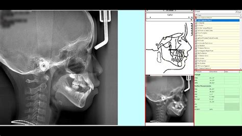 How To Tracing Cephalometric Day 6 Sharing Youtube