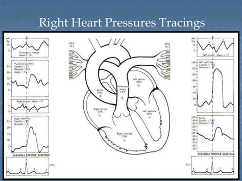 Ppt Right Heart Catheterization Basic Right Heart Pressure Tracings