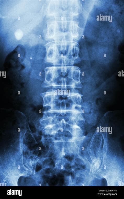 Film X Ray Kub Kidney Ureter Bladder Show Right Renal Stone