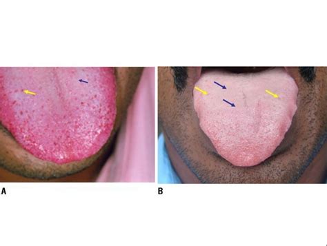 Filiform Papillae Tongue