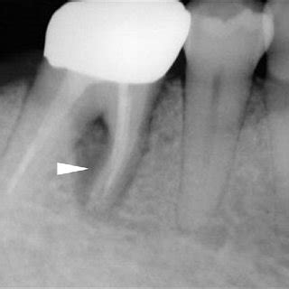 (PDF) Differentiating spontaneous vertical root fracture in ...