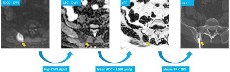 Right Iliac Crest Metastasis In A 56 Year Old Prostate Cancer Patient Download Scientific