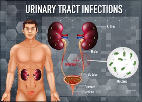 Ilustración Informativa De Infecciones Del Tracto Urinario Vector Gratis