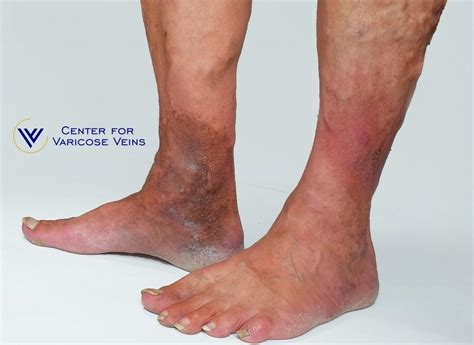 What S The Connection Between Varicose Veins And Skin Discoloration