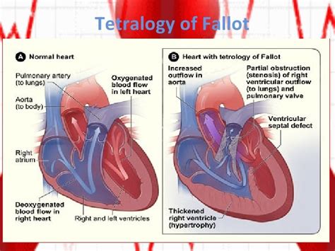 Cyanotic Heart Defects