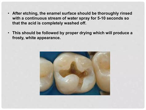 Bonding To Enamel Dentin Ppt