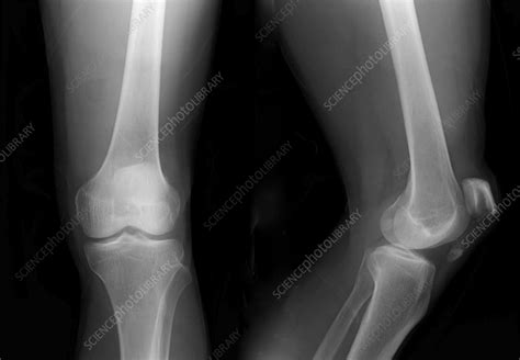 Broken knee cap, X-ray - Stock Image - F036/0217 - Science Photo Library