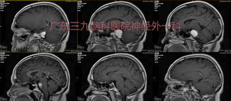 左侧跨中后颅窝岩斜区脑膜瘤切除术 脑医汇 神外资讯 神介资讯