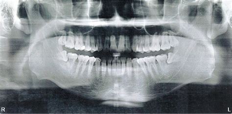 33m Horizontal Wisdom Teeth Close To The Nerves Scared And Looking For Advice Wisdomteeth