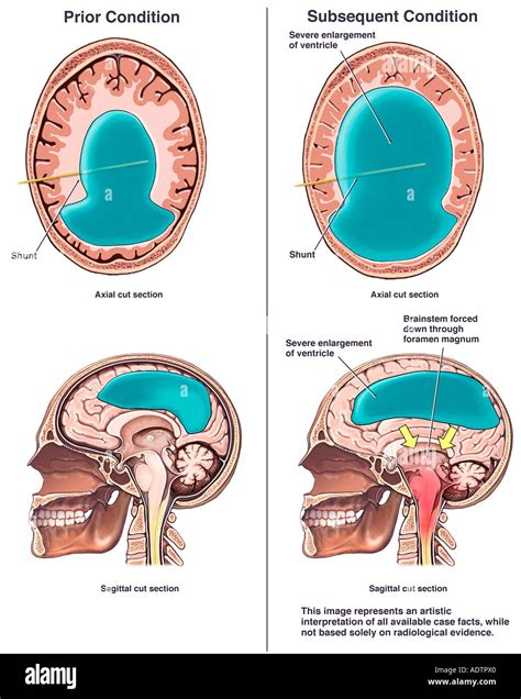 Hydrocephalus Hi Res Stock Photography And Images Alamy