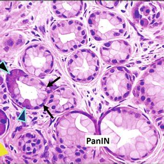 H E Staining Of Pancreatic Tissue Section Derived From Pdx Cre