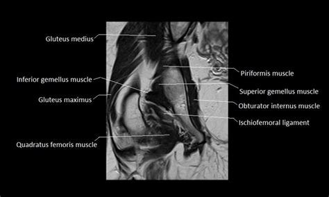 Iliofemoral Ligament Mri