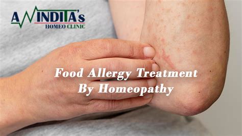 Homeopathy Facts Important Facts Of Homoeopathy Treatments