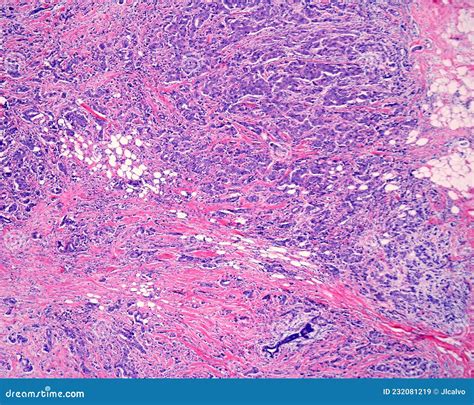 Menschliche Brust Invasives Karzinom Stockbild Bild Von Dr Se Brust