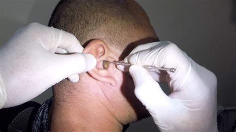 Man S Massive Earwax Removed From His Ear Youtube