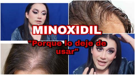 Minoxidil El Tratamiento Para Crecer El Cabello Por Qu Lo Deje De