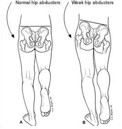 Trendelenburg Test - Pediatric Hip Pain