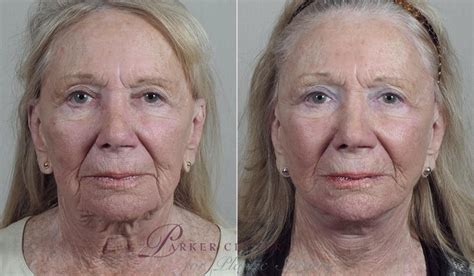 Facelift Before And After Pictures Case 1180 Paramus New Jersey Parker Center For Plastic