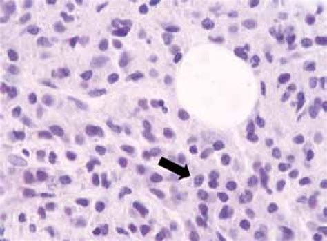 Hematoxylin And Eosin Stain Of Bone Marrow Biopsy Showing Massively