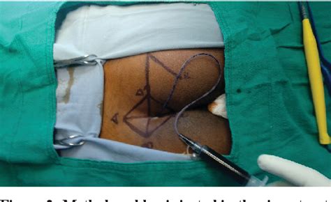 Figure 2 From Rhomboid Excision And Limberg Flap Operation For Managing