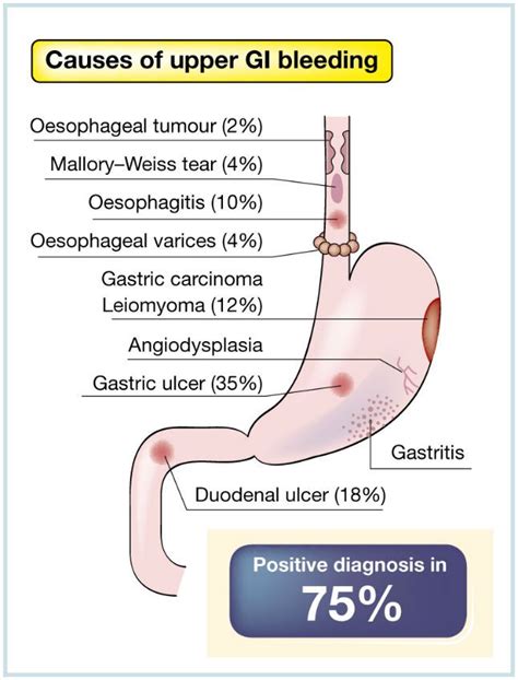 Symptoms Of A Upper Gi Bleed