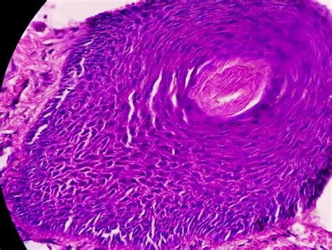 Biopsia De Piel Bajo Microscopía Sugestiva De Carcinoma De Células