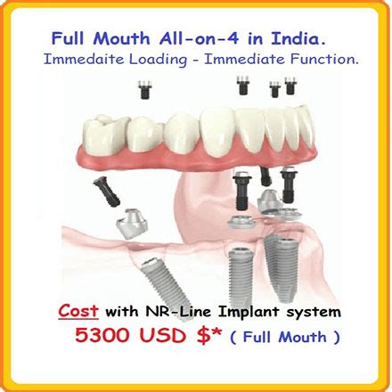 All-On-4 Implant Procedure India ~ Dental Crown Delhi