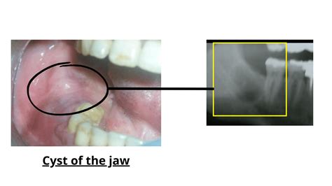 Lump On Jawline After Wisdom Tooth Extraction Infoupdate Org