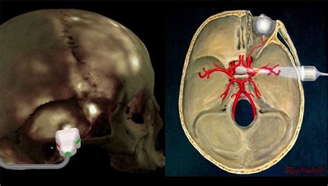 Frontiers Transcranial Doppler Ultrasonography As A Off