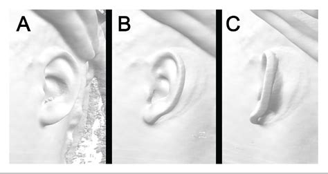 Figure 1 From Fabrication Of 3D Models For Microtia Reconstruction