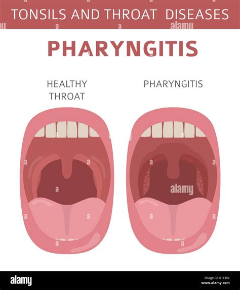 Tonsils And Throat Diseases Pharyngitis Symptoms Treatment Icon Set