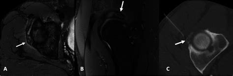 Acute Calcific Periarthritisa Commonly Misdiagnosed Pathology Pmc