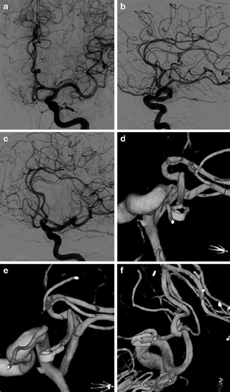 Postoperative Digital Subtraction Angiography A C Corresponding