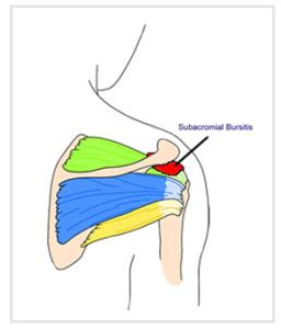 Subacromial Bursitis Natural Treatment | OSMO Patch US