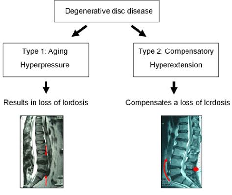 Classification Of Degenerative Disc Diseases Into Aging Discopathy And