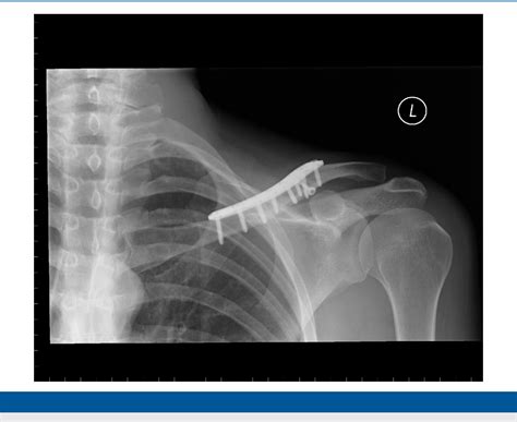 Figure 1 From Midshaft Clavicular Fractures Surgical Technique