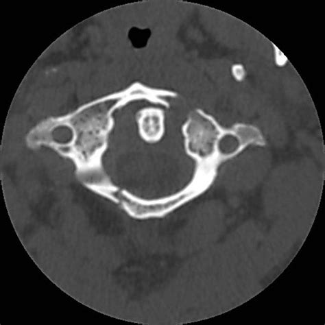 Jefferson fracture | Radiology Case | Radiopaedia.org