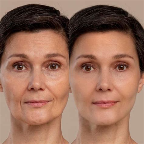 Ultraformer Facial Clinicabse