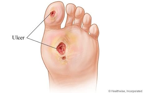 Foot Ulcers - A Complication Of Diabetes - Sutherland Podiatry ...