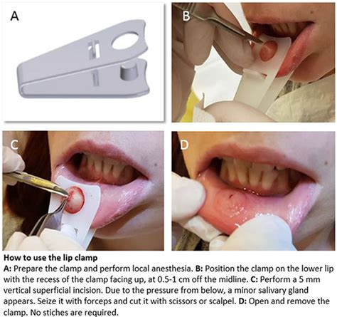 Sat0189 A Novel Device For Rapid Minor Salivary Gland Biopsy In Suspected SjÖgrens Syndrome