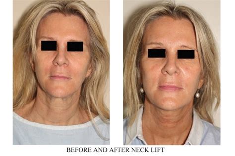 Platysmaplasty Or Neck Lift Surgery Dr Denton