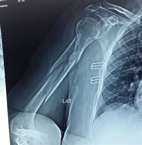 Humeral Shaft Fractures Trauma Orthobullets