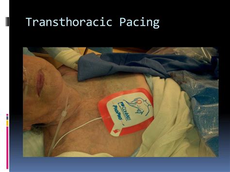 What Is A Transthoracic Pacemaker Images And Photos Finder